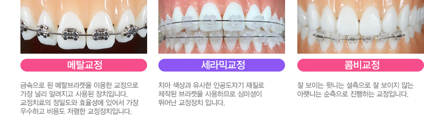 경제적인 비용, 튼튼한 교정을 원한다면?