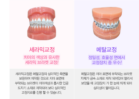 메탈교정vs세라믹교정