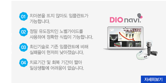 네비게이션임플란트(디오나비)