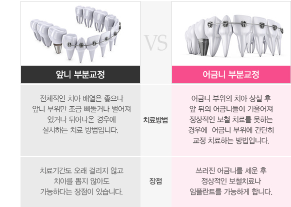 앞니부분교정VS어금니부분교정