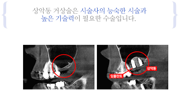 상악동 거상술이란?