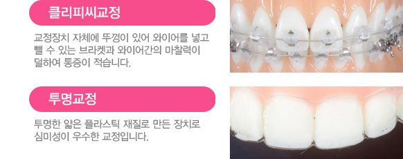 치아교정 서울베스트치과 장치별특징