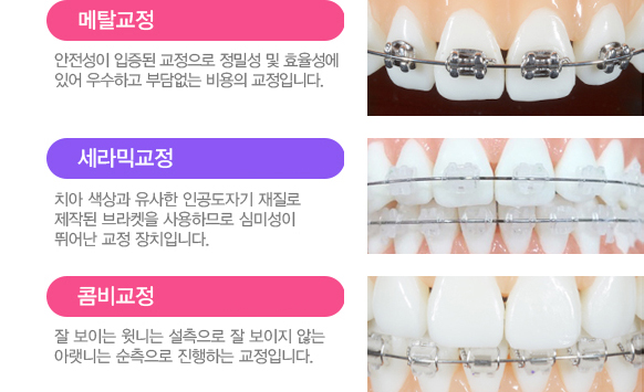 치아교정 서울베스트치과 장치별특징