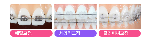 덧니교정