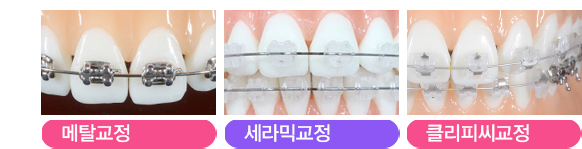 부정교합교정