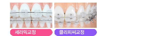 뻐드렁니교정