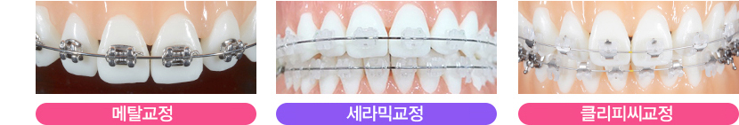 덧니교정