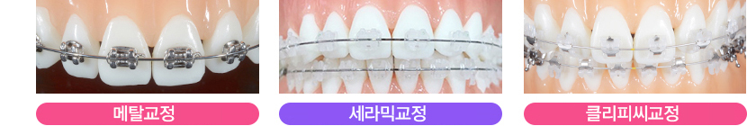 부정교합교정